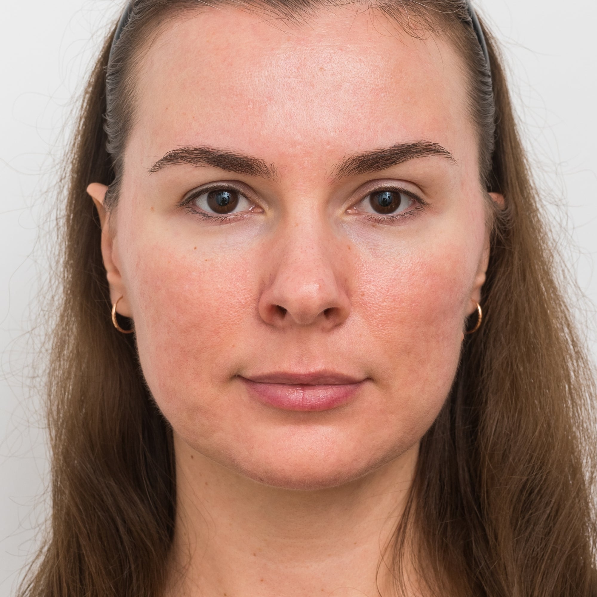 Rosacea potem