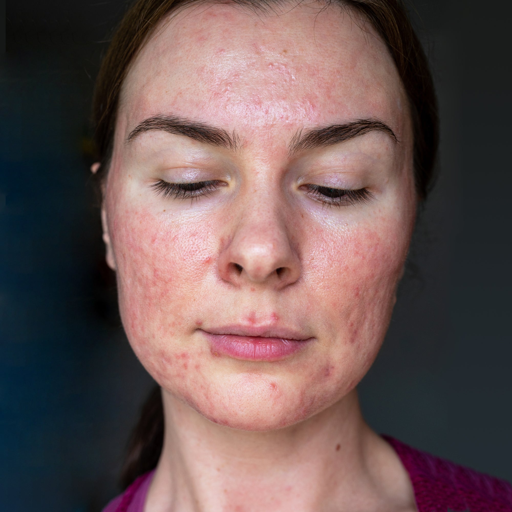 rosacea prej