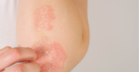 Luskavica oz. psoriaza - bolezen, ki seže globoko pod kožo