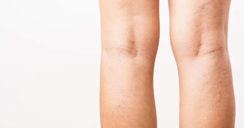 Krčne žile – Preventivni ukrepi, ki vam lahko pomagajo