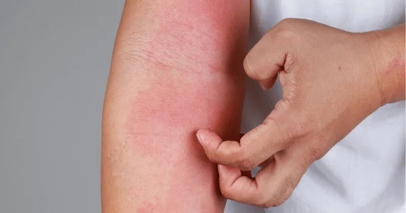 Kaj povzroča dermatitis in kako ublažiti simptome? - Gaia Naturelle