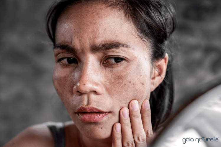 Pigmentni madeži - preventiva in odstranjevanje - Gaia Naturelle