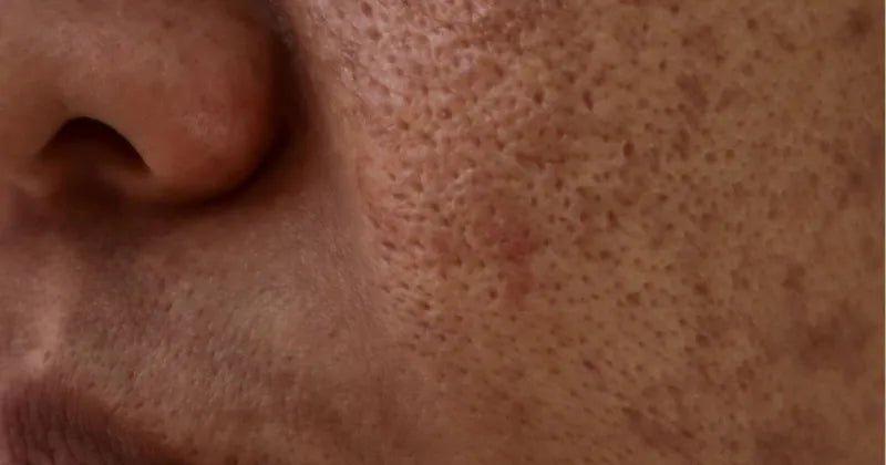 Razumevanje hiperpigmentacije - vrste, vzroki in rešitve - Gaia Naturelle