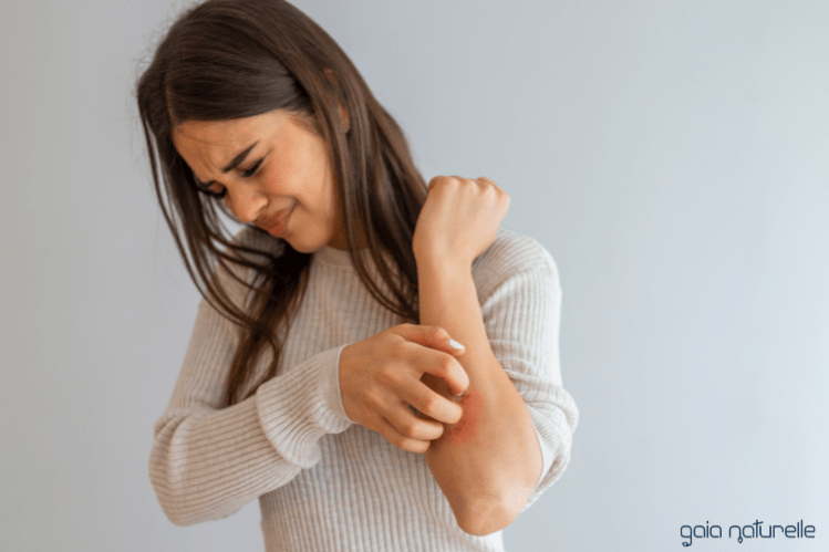 Seboroični dermatitis: vse, kar morate vedeti in 7 pogostih napak pri zdravljenju - Gaia Naturelle
