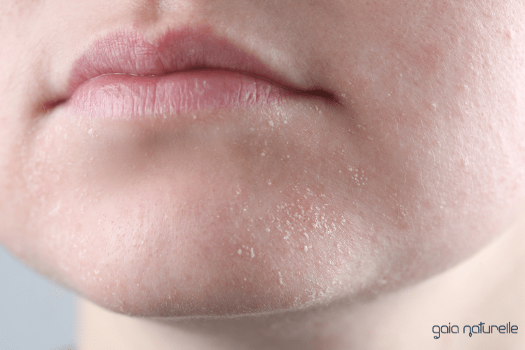 Suha koža: 10 presenetljivih vzrokov in 8 naravnih rešitev - Gaia Naturelle