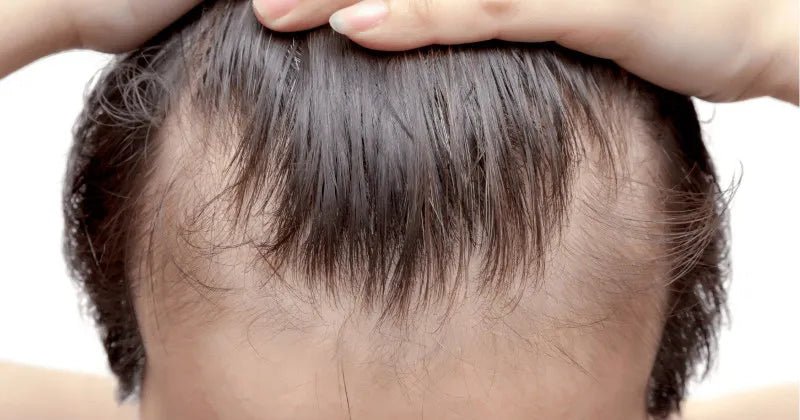 Vse kar morate vedeti o alopeciji oz. krožnem izpadanju las - Gaia Naturelle
