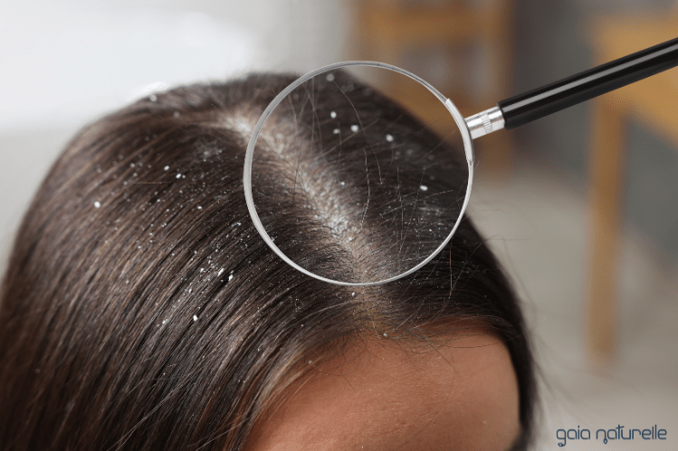 Zakaj se pojavi prhljaj? - Gaia Naturelle