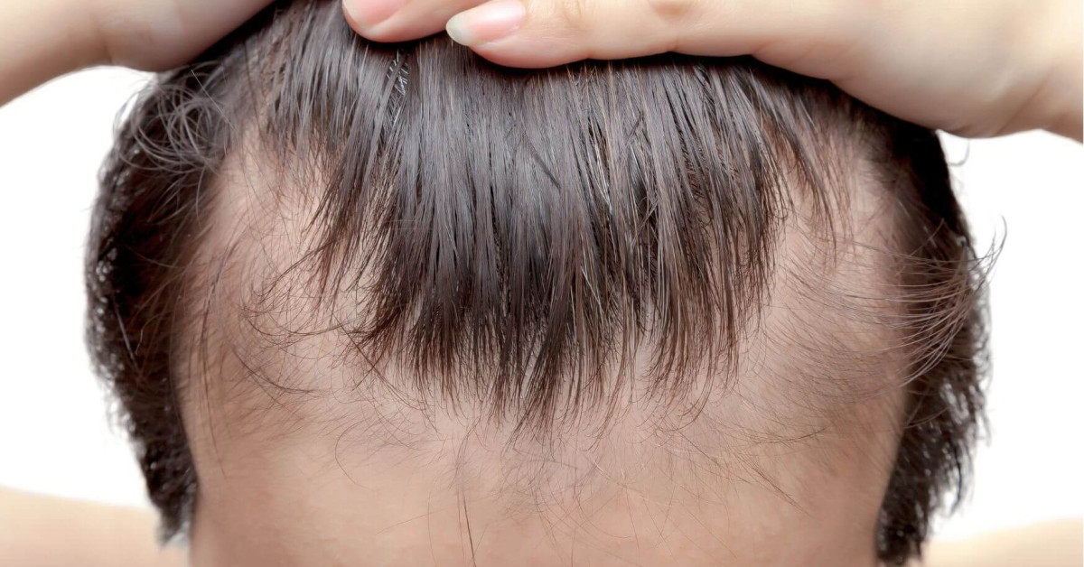 bomuld Smitsom Resignation Everything you need to know about alopecia or circular hair loss - Gaia  Naturelle