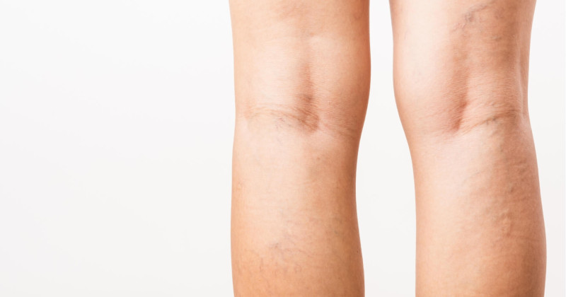 Varicose veins - Preventive measures that can help you
