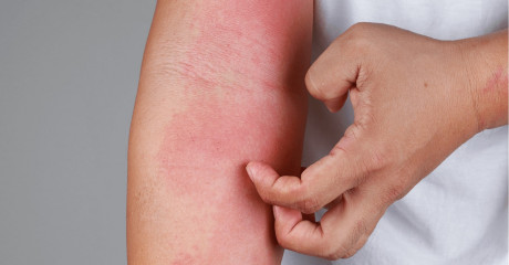 Kaj povzroča dermatitis in kako ublažiti simptome?