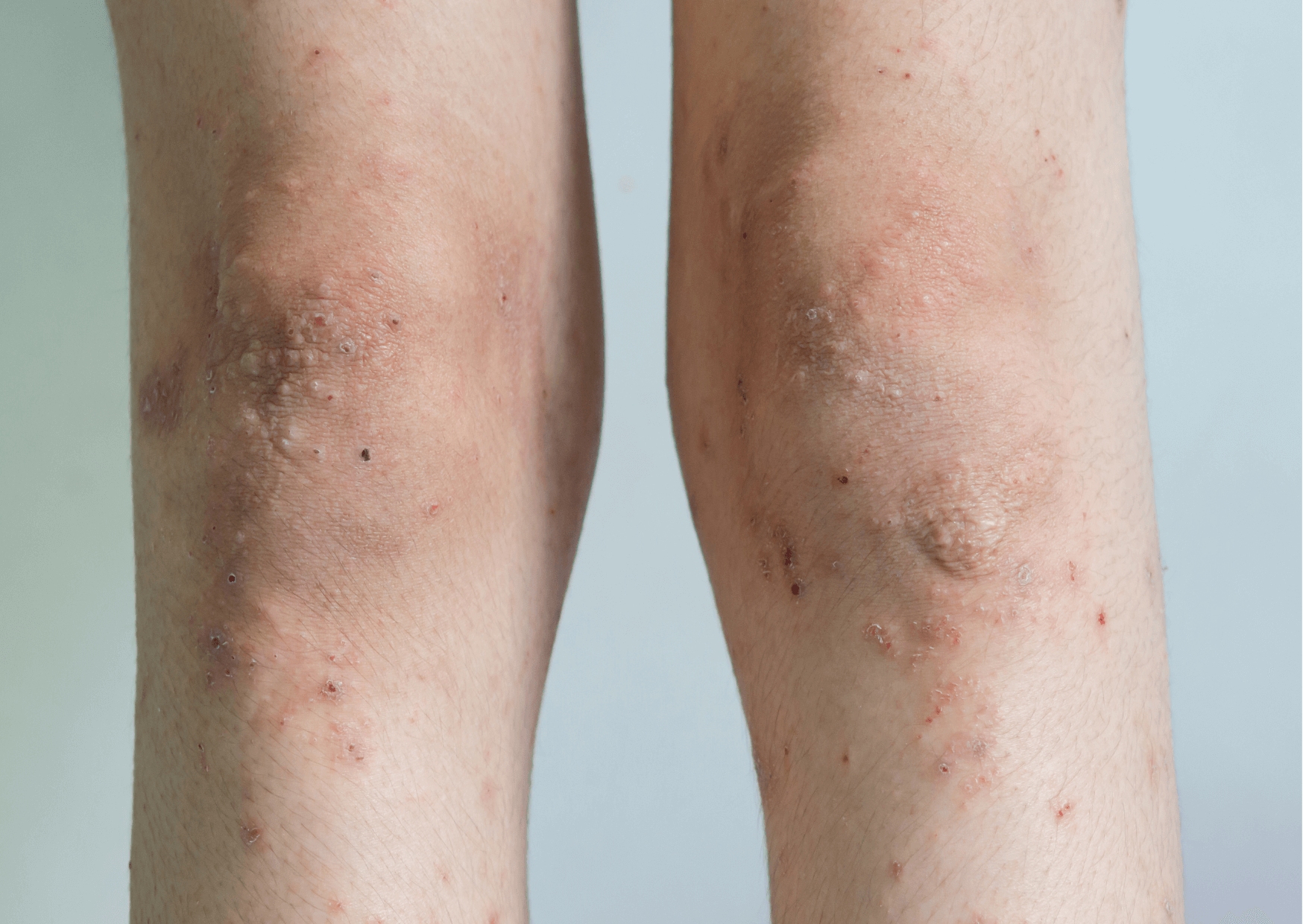 Dermatitis na nogi