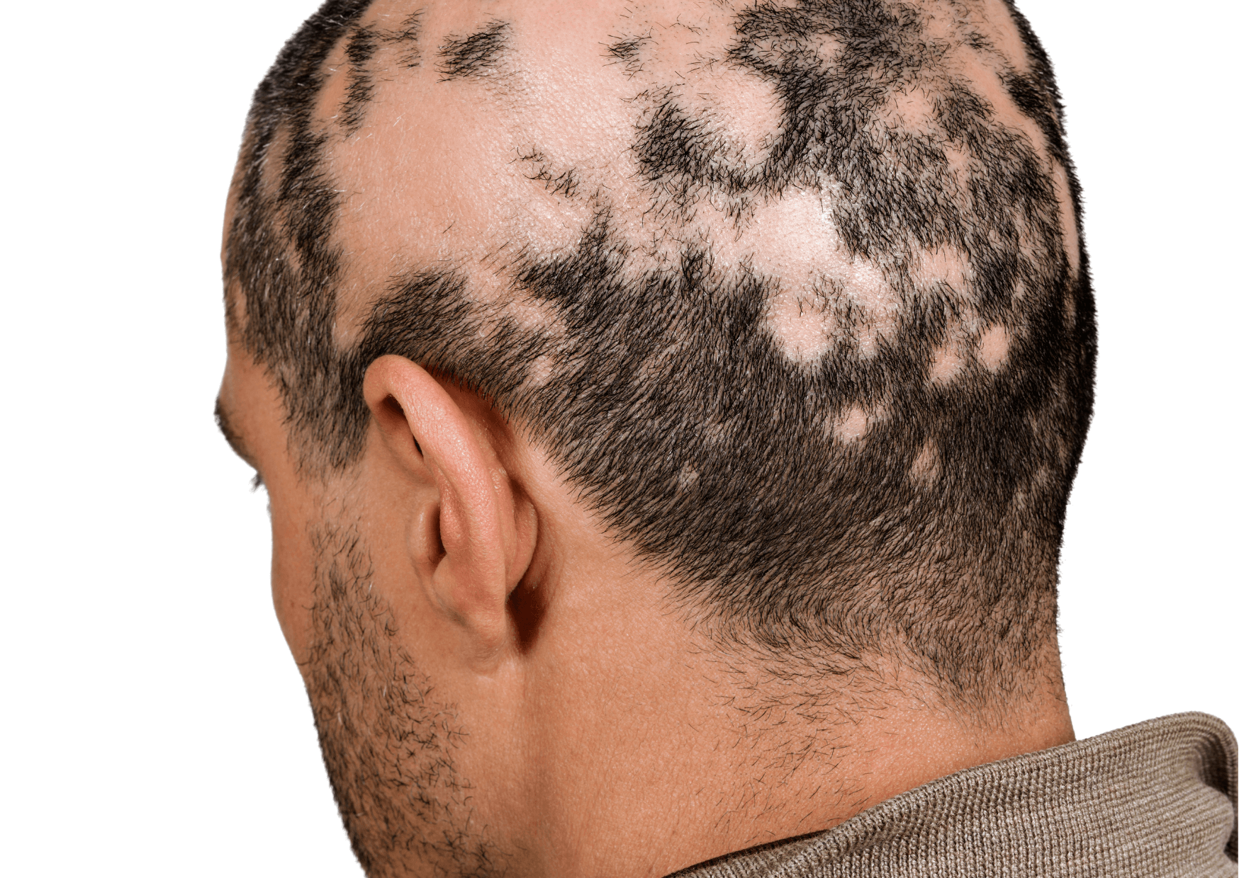 Alopecija - krožno izpadanje las