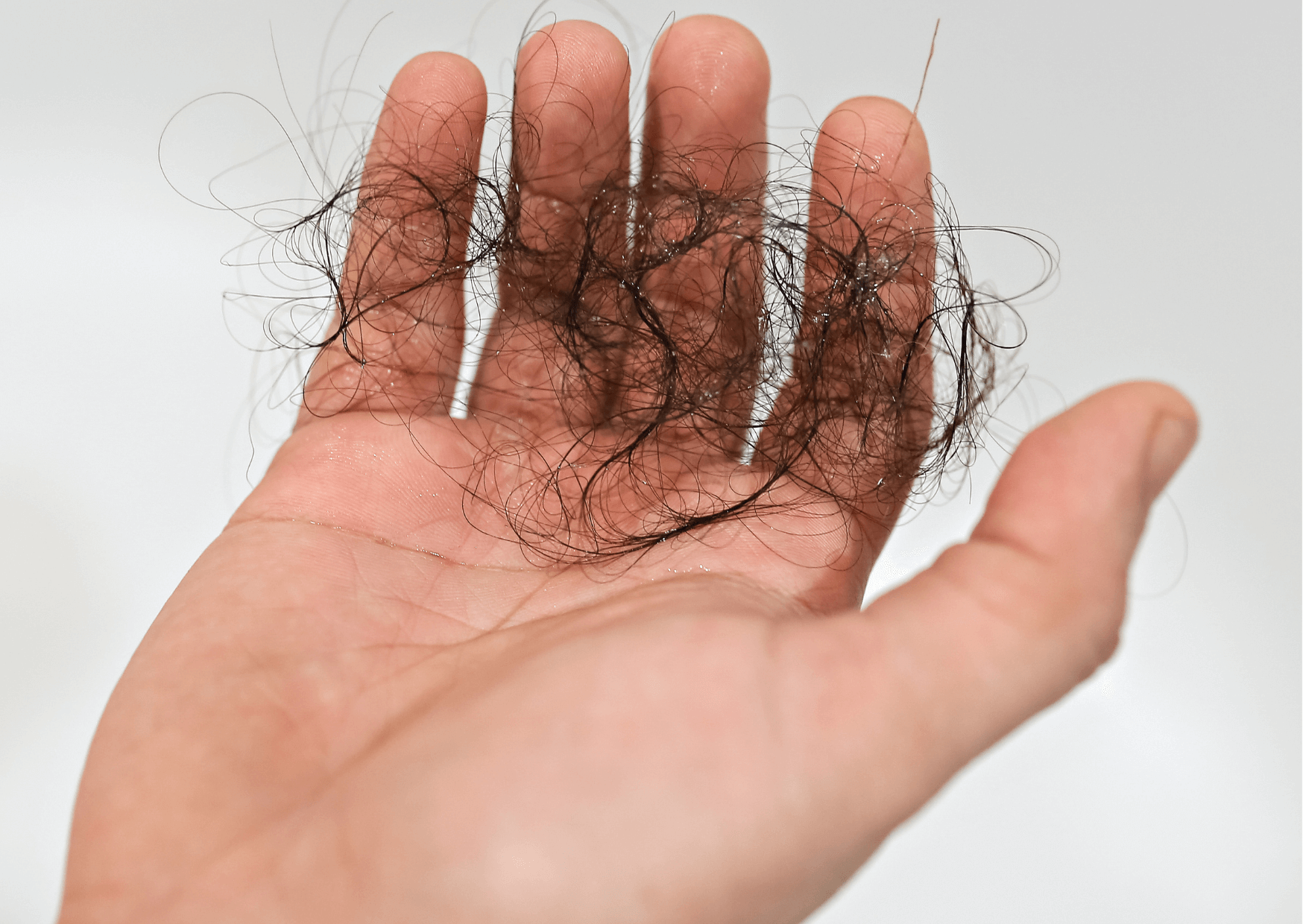 Alopecija - nenadno izpadanje las