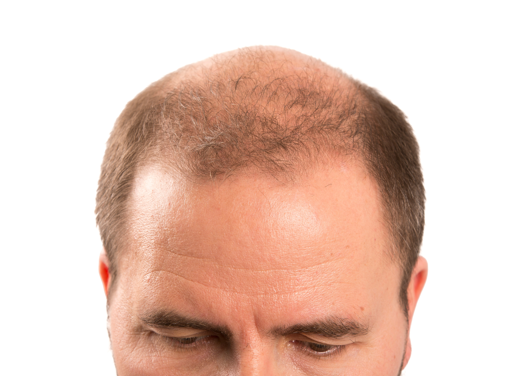 Alopecija - redčenje las na vrhu glave