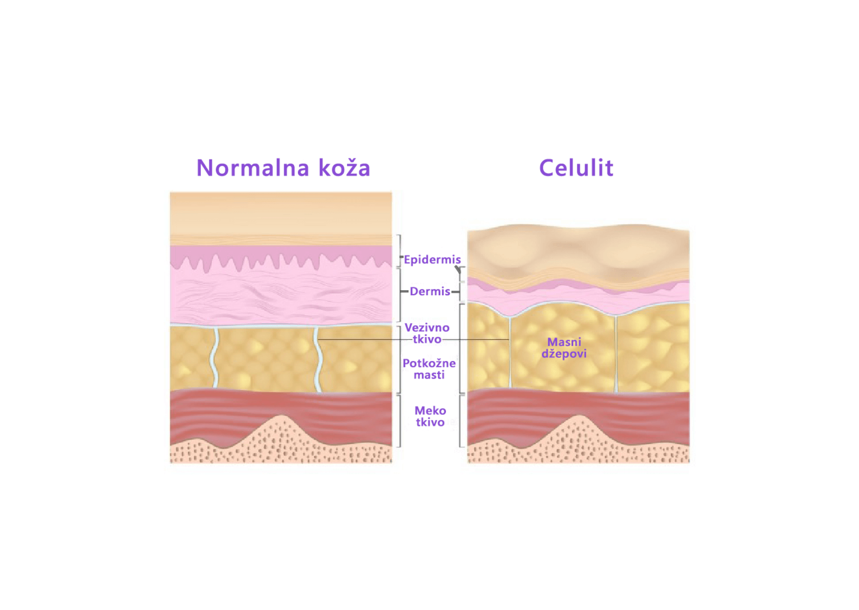 Celulit in normalna koža