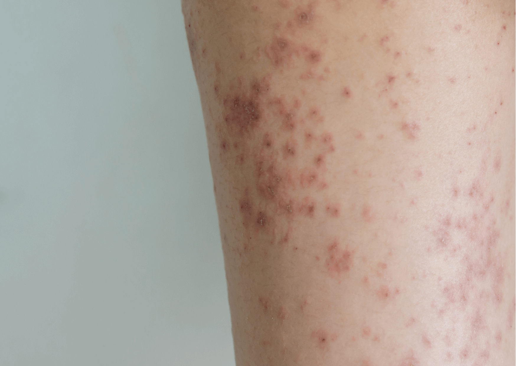 Vpliv hrane na dermatitis