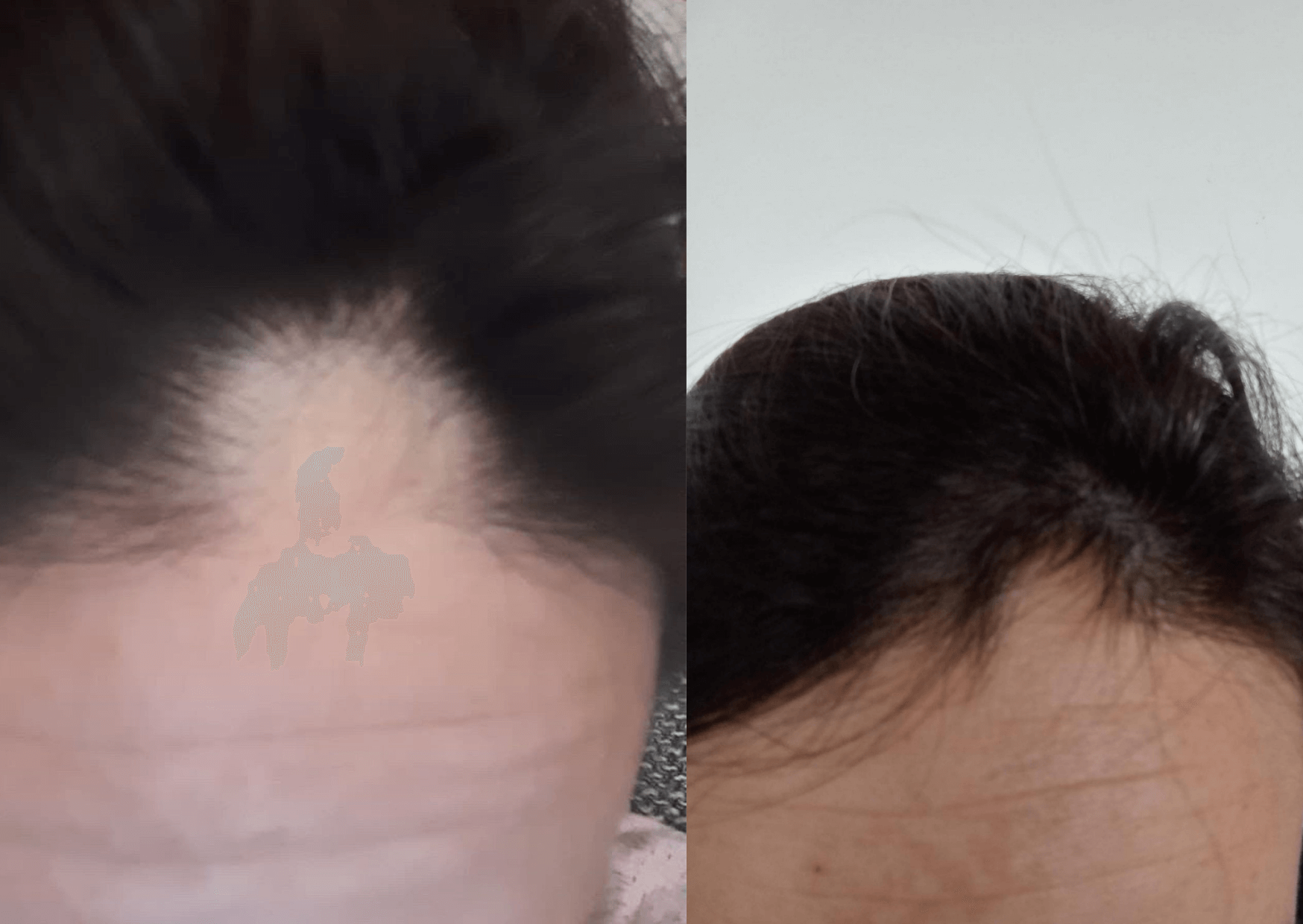 Izpadanje las - rezultati Kolagen shota