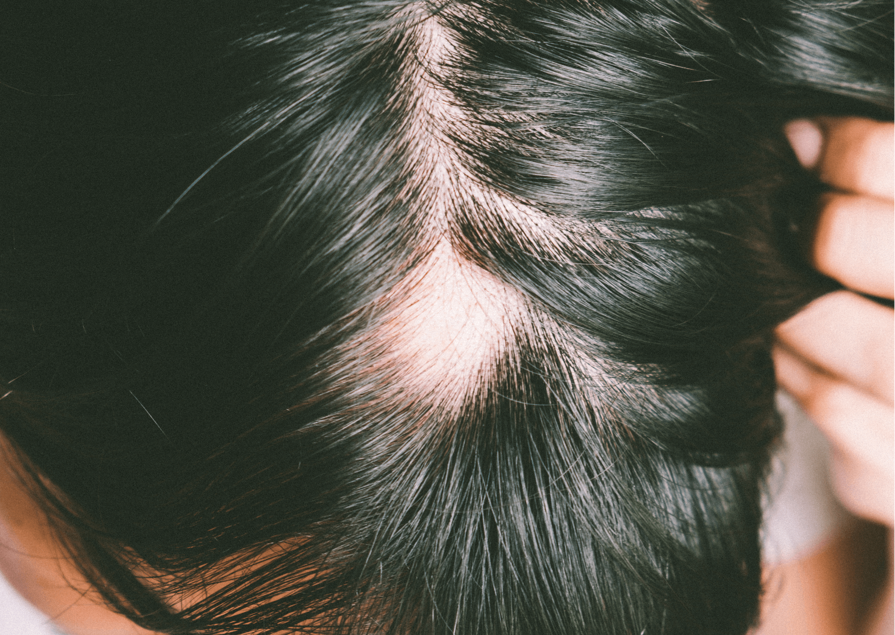 Izpadanje las pri ženskah
