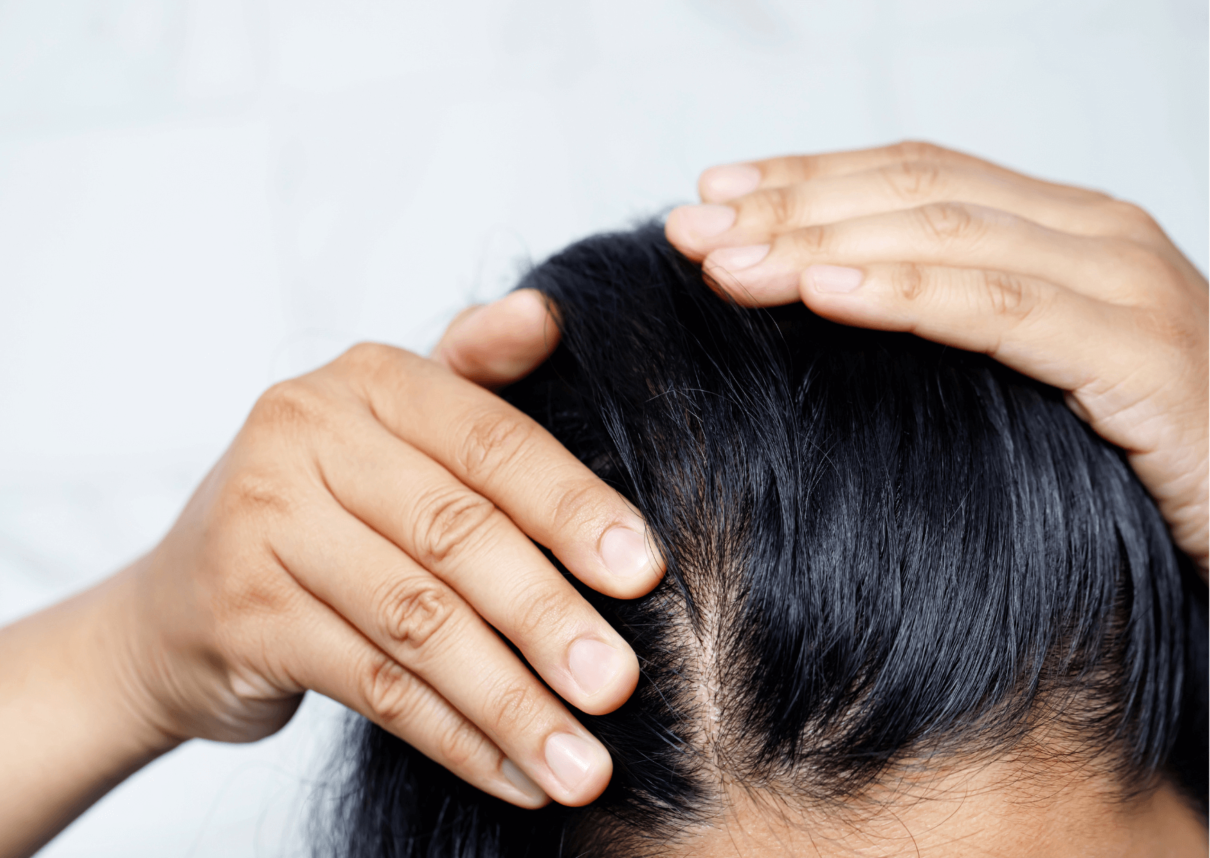 What is alopecia