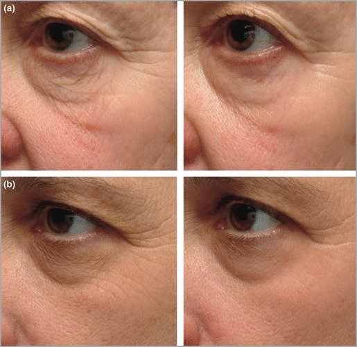 Serumi za obraz - vpliv niacinamida na kožo